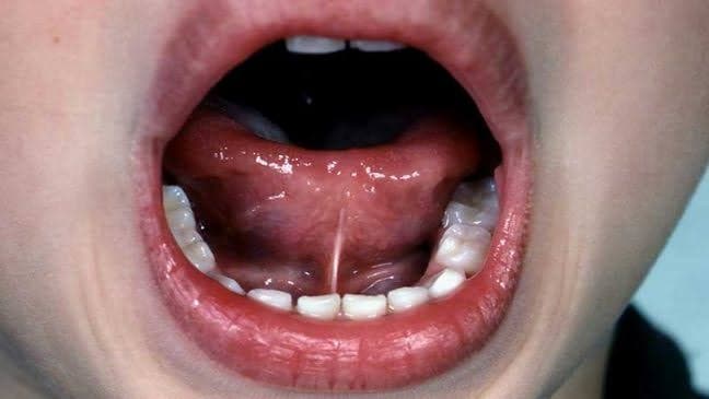 Dil Bağı Konuşmayı Geciktirir mi?